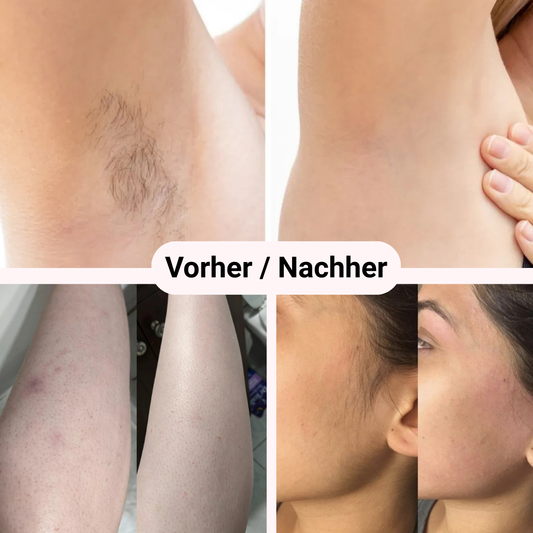 Removely IPL 5+ (inkl. Summer Sale Geschenk)